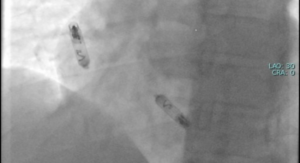 Pacemaker bilaterale
