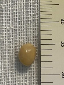 Eboli, intervento salva-vita: rimosso corpo estraneo dal polmone di una 70enne in anestesia locale