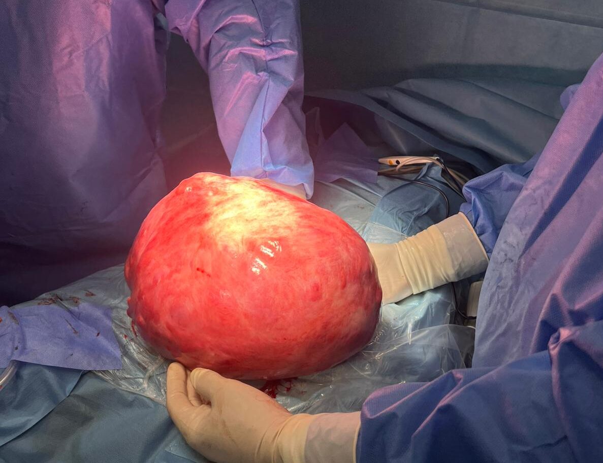 Tumore 10 kg